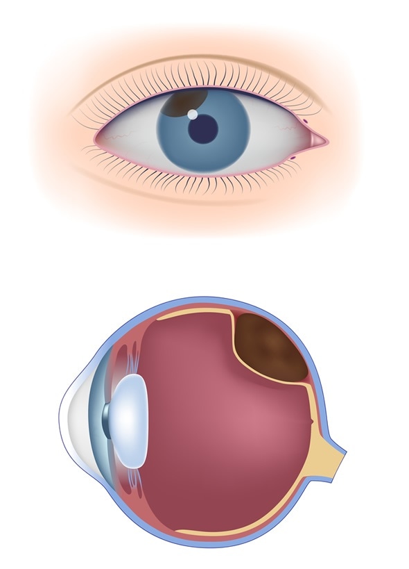 Uveal melanoma - Image Copyright: Alila Medical Media / Shutterstock